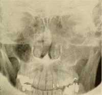 An illustration from Oral Roentgenology : a Roentgen study of the anatomy and pathology of the oral cavity (1917)