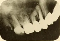 An illustration from Oral Roentgenology : a Roentgen study of the anatomy and pathology of the oral cavity (1917)