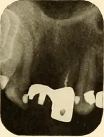 Picture 119 of 158 from Oral Roentgenology : a Roentgen study of the anatomy and pathology of the oral cavity (1917), leaf 170
