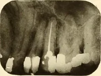 Picture 120 of 158 from Oral Roentgenology : a Roentgen study of the anatomy and pathology of the oral cavity (1917), leaf 170