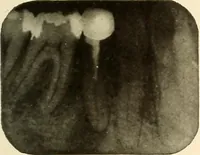 An illustration from Oral Roentgenology : a Roentgen study of the anatomy and pathology of the oral cavity (1917)