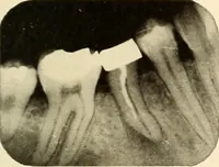 Picture 122 of 158 from Oral Roentgenology : a Roentgen study of the anatomy and pathology of the oral cavity (1917), leaf 170