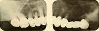 Picture 123 of 158 from Oral Roentgenology : a Roentgen study of the anatomy and pathology of the oral cavity (1917), leaf 172