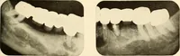 An illustration from Oral Roentgenology : a Roentgen study of the anatomy and pathology of the oral cavity (1917)