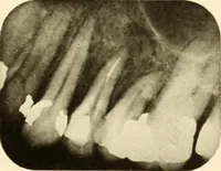 Picture 125 of 158 from Oral Roentgenology : a Roentgen study of the anatomy and pathology of the oral cavity (1917), leaf 174