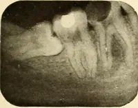 An illustration from Oral Roentgenology : a Roentgen study of the anatomy and pathology of the oral cavity (1917)