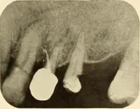 An illustration from Oral Roentgenology : a Roentgen study of the anatomy and pathology of the oral cavity (1917)