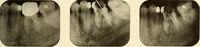 Picture 128 of 158 from Oral Roentgenology : a Roentgen study of the anatomy and pathology of the oral cavity (1917), leaf 176