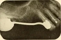 Picture 130 of 158 from Oral Roentgenology : a Roentgen study of the anatomy and pathology of the oral cavity (1917), leaf 178