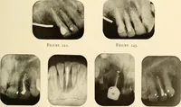 An illustration from Oral Roentgenology : a Roentgen study of the anatomy and pathology of the oral cavity (1917)