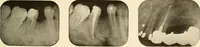 Picture 132 of 158 from Oral Roentgenology : a Roentgen study of the anatomy and pathology of the oral cavity (1917), leaf 178