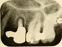 Picture 133 of 158 from Oral Roentgenology : a Roentgen study of the anatomy and pathology of the oral cavity (1917), leaf 180