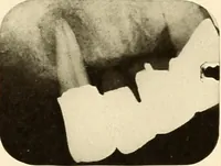 An illustration from Oral Roentgenology : a Roentgen study of the anatomy and pathology of the oral cavity (1917)