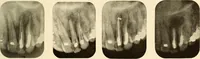 An illustration from Oral Roentgenology : a Roentgen study of the anatomy and pathology of the oral cavity (1917)