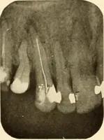 Picture 136 of 158 from Oral Roentgenology : a Roentgen study of the anatomy and pathology of the oral cavity (1917), leaf 182