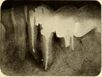 Picture 137 of 158 from Oral Roentgenology : a Roentgen study of the anatomy and pathology of the oral cavity (1917), leaf 182