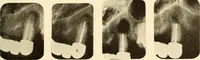 Picture 138 of 158 from Oral Roentgenology : a Roentgen study of the anatomy and pathology of the oral cavity (1917), leaf 184