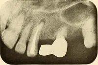 An illustration from Oral Roentgenology : a Roentgen study of the anatomy and pathology of the oral cavity (1917)