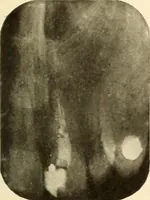 An illustration from Oral Roentgenology : a Roentgen study of the anatomy and pathology of the oral cavity (1917)