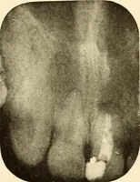 An illustration from Oral Roentgenology : a Roentgen study of the anatomy and pathology of the oral cavity (1917)