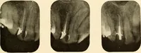Picture 143 of 158 from Oral Roentgenology : a Roentgen study of the anatomy and pathology of the oral cavity (1917), leaf 188