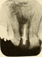Picture 144 of 158 from Oral Roentgenology : a Roentgen study of the anatomy and pathology of the oral cavity (1917), leaf 188