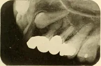 An illustration from Oral Roentgenology : a Roentgen study of the anatomy and pathology of the oral cavity (1917)