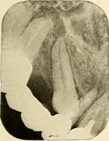 An illustration from Oral Roentgenology : a Roentgen study of the anatomy and pathology of the oral cavity (1917)