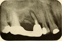 Picture 147 of 158 from Oral Roentgenology : a Roentgen study of the anatomy and pathology of the oral cavity (1917), leaf 190
