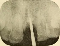 Picture 149 of 158 from Oral Roentgenology : a Roentgen study of the anatomy and pathology of the oral cavity (1917), leaf 192