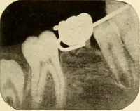 Picture 151 of 158 from Oral Roentgenology : a Roentgen study of the anatomy and pathology of the oral cavity (1917), leaf 194