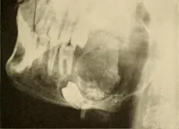An illustration from Oral Roentgenology : a Roentgen study of the anatomy and pathology of the oral cavity (1917)