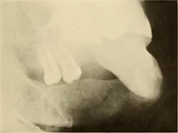 An illustration from Oral Roentgenology : a Roentgen study of the anatomy and pathology of the oral cavity (1917)