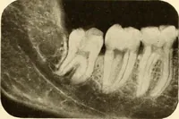 Picture 1 of 158 from Oral Roentgenology : a Roentgen study of the anatomy and pathology of the oral cavity (1917), leaf 22
