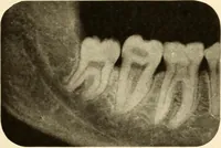 An illustration from Oral Roentgenology : a Roentgen study of the anatomy and pathology of the oral cavity (1917)