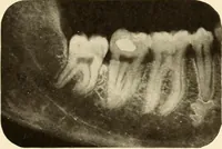 Picture 3 of 158 from Oral Roentgenology : a Roentgen study of the anatomy and pathology of the oral cavity (1917), leaf 22