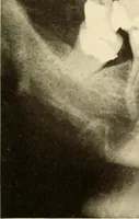 An illustration from Oral Roentgenology : a Roentgen study of the anatomy and pathology of the oral cavity (1917)
