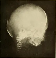 An illustration from Oral Roentgenology : a Roentgen study of the anatomy and pathology of the oral cavity (1917)