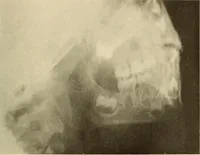 An illustration from Oral Roentgenology : a Roentgen study of the anatomy and pathology of the oral cavity (1917)