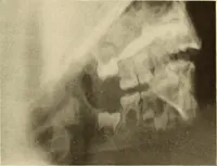 An illustration from Oral Roentgenology : a Roentgen study of the anatomy and pathology of the oral cavity (1917)