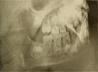 An illustration from Oral Roentgenology : a Roentgen study of the anatomy and pathology of the oral cavity (1917)