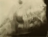 Picture 12 of 158 from Oral Roentgenology : a Roentgen study of the anatomy and pathology of the oral cavity (1917), leaf 38