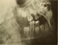 Picture 13 of 158 from Oral Roentgenology : a Roentgen study of the anatomy and pathology of the oral cavity (1917), leaf 40