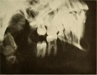 An illustration from Oral Roentgenology : a Roentgen study of the anatomy and pathology of the oral cavity (1917)