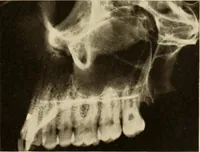 An illustration from Oral Roentgenology : a Roentgen study of the anatomy and pathology of the oral cavity (1917)