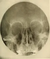 An illustration from Oral Roentgenology : a Roentgen study of the anatomy and pathology of the oral cavity (1917)