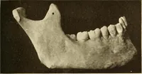 An illustration from Oral Roentgenology : a Roentgen study of the anatomy and pathology of the oral cavity (1917)