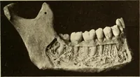An illustration from Oral Roentgenology : a Roentgen study of the anatomy and pathology of the oral cavity (1917)