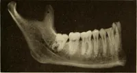 An illustration from Oral Roentgenology : a Roentgen study of the anatomy and pathology of the oral cavity (1917)