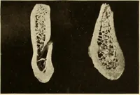 An illustration from Oral Roentgenology : a Roentgen study of the anatomy and pathology of the oral cavity (1917)